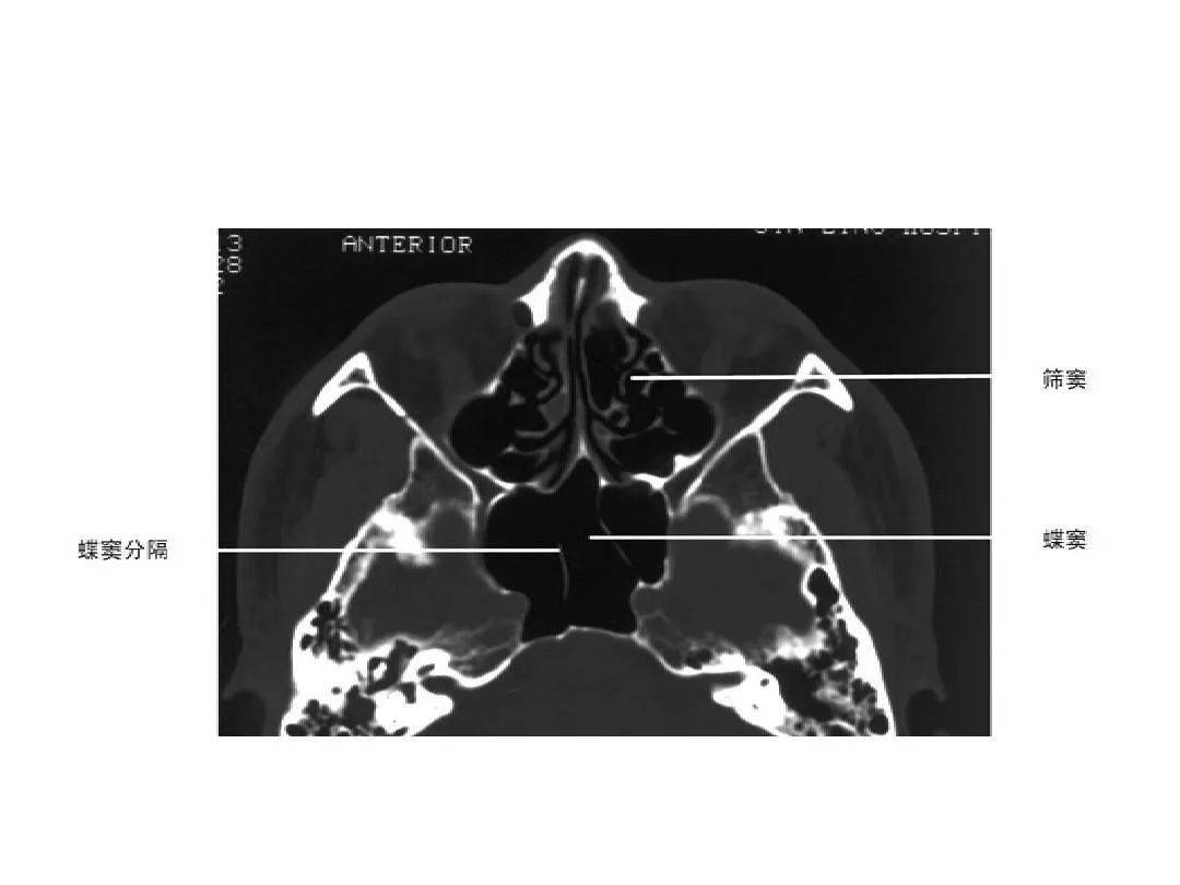 鼻窦轴位平扫ct解剖图图片