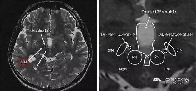 红核左右各一,位于中脑中线的两侧,黑质之背内侧.