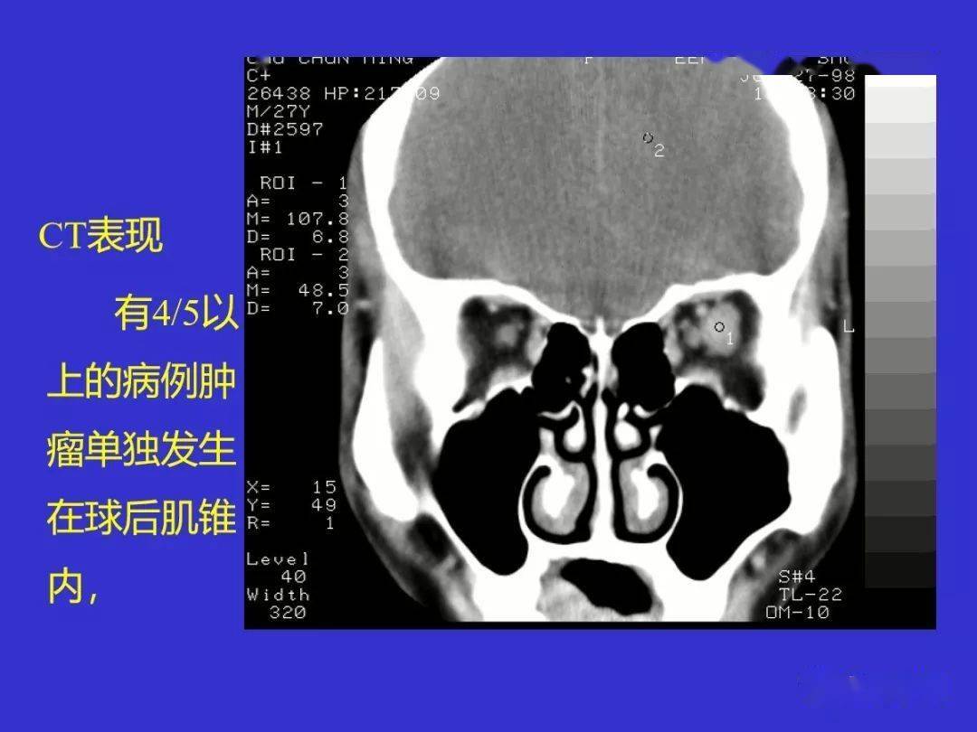 眼眶腫瘤ct診斷和鑑別診斷