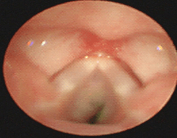 需要,临床常采取抢救性气管内插管,但插管后易发生声门部及声门下狭窄