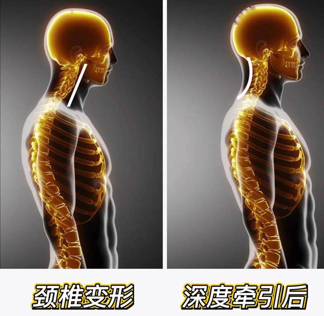 每天3分鐘頸椎爽到爆世界冠軍力推按摩牽引器