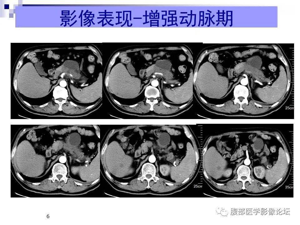 胰腺丨浸润性导管腺癌