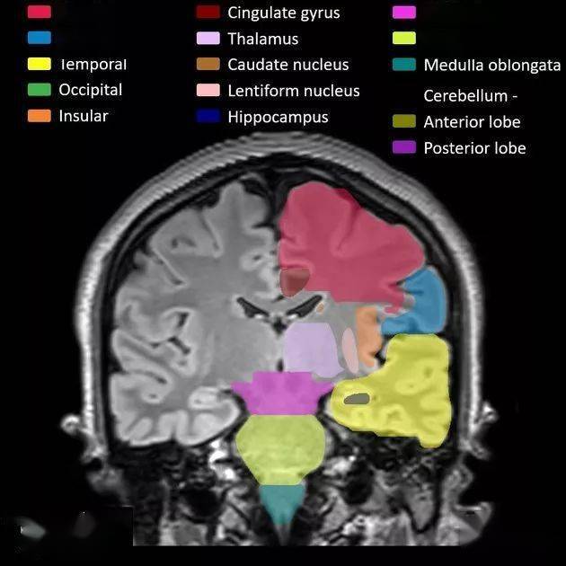 frontal 額葉parietal 頂葉temporal 顳葉occipital 枕葉insular 島葉