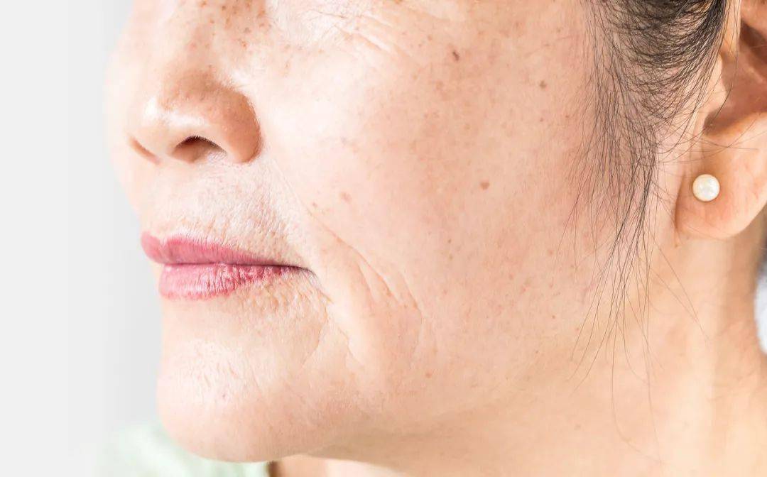 衰老:主要体现在长皱纹,色斑,脸部肌肤下垂,苹果肌干瘪,失去弹性