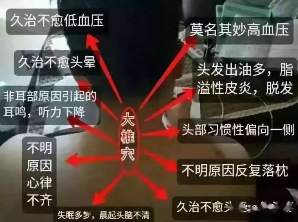 从中医来看,富贵包对应着大椎穴,因为大椎穴是人体的