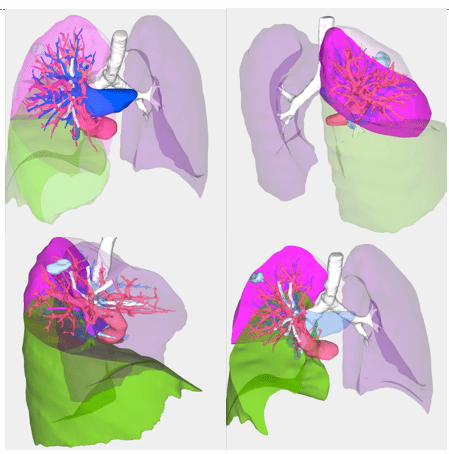 术前肺结节三维重建