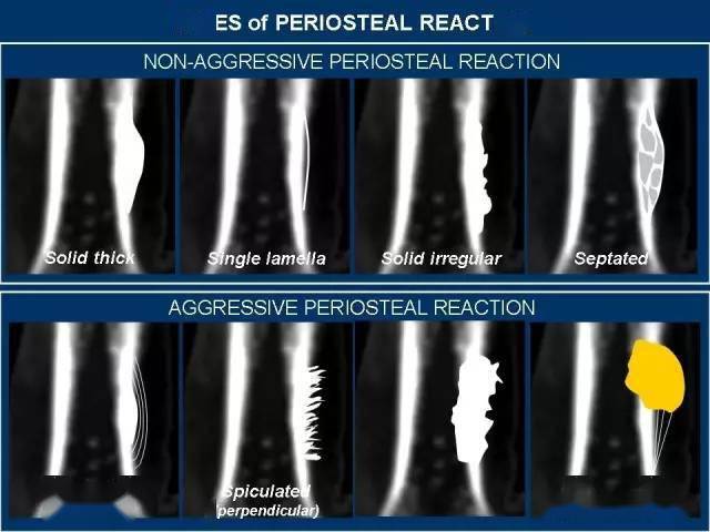骨膜反应图片图片