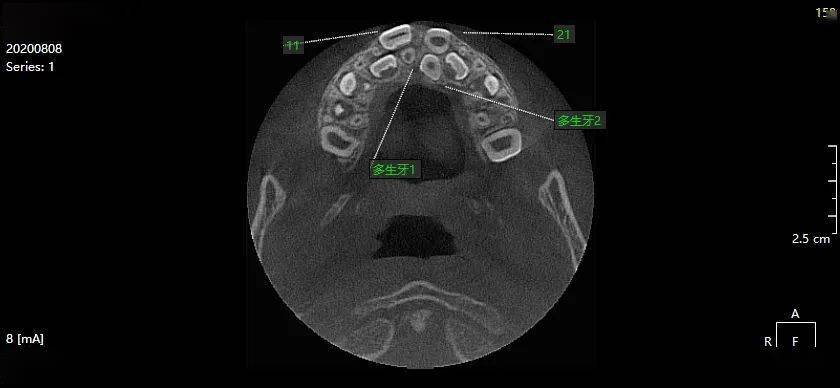 黄xx 20200808 多生牙cbct 137xxxx7962