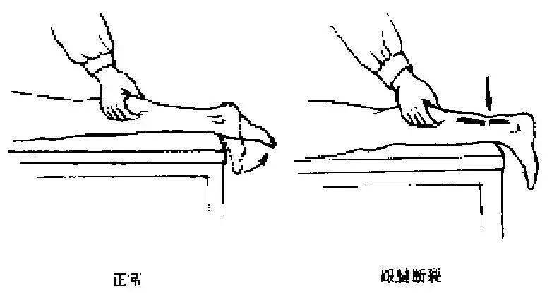 运动损伤检查及处理方法非常实用