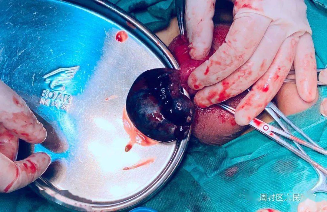 切除睾丸手术全过程图片