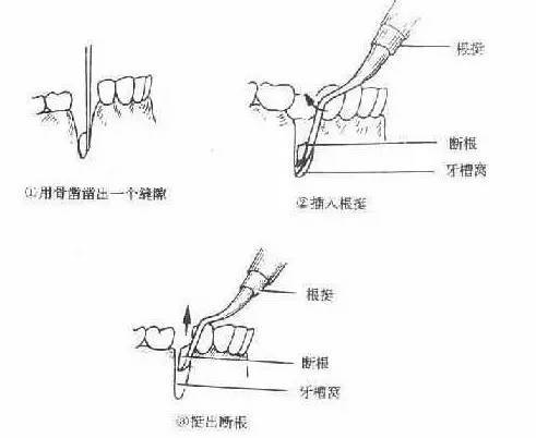 口腔常用的牙挺种类及使用