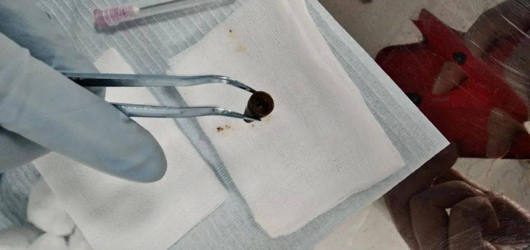 咽部不适,竟是"藏匿"气管十几年笔帽惹的祸_异物