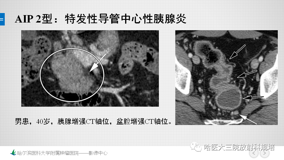 慢性胰腺炎与胰腺癌的影像学鉴别诊断思路