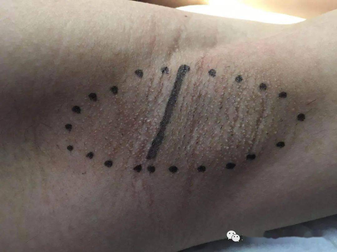 "微创腋臭切除术"--小切口解决大尴尬_伤口