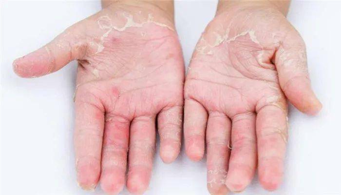 病因真菌性皮肤病的主要致病菌为皮肤癣菌,包括黄癣菌,白癣菌,红色毛