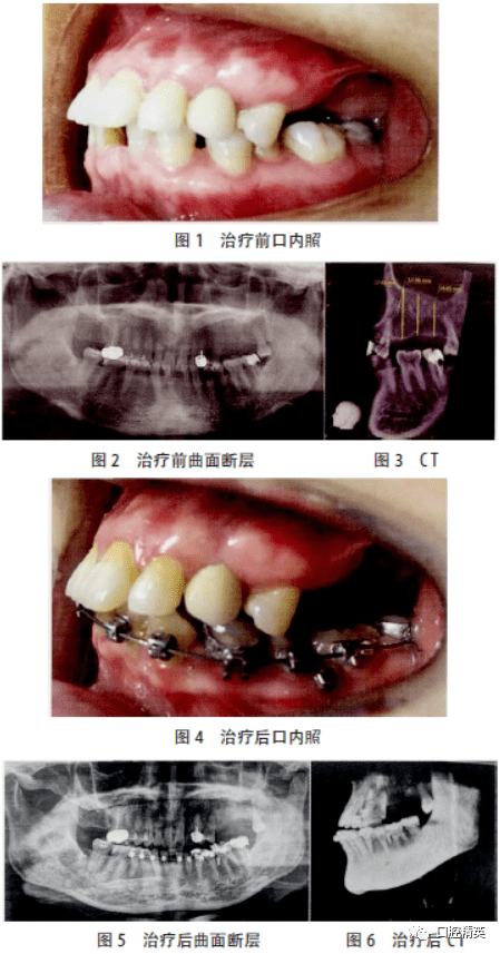 微种植体支抗联合牙合垫压低下颌双尖牙及多颗磨牙1例