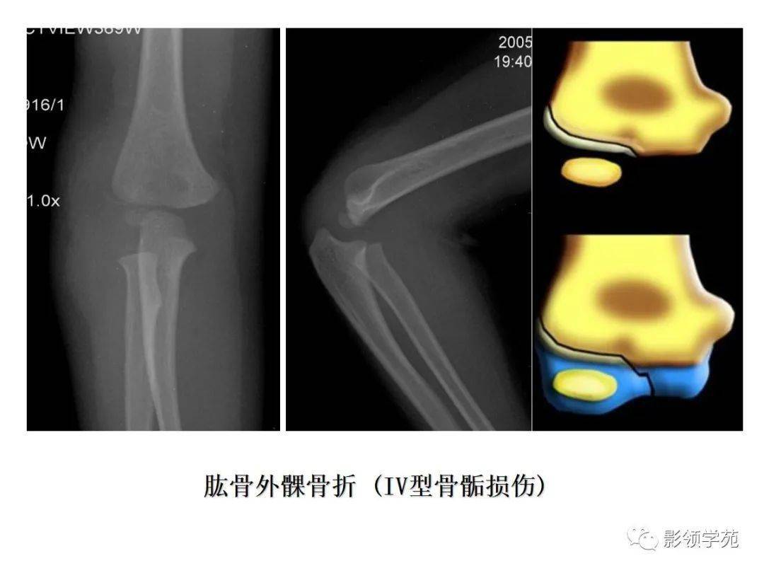 儿童长骨x线解剖特点图片