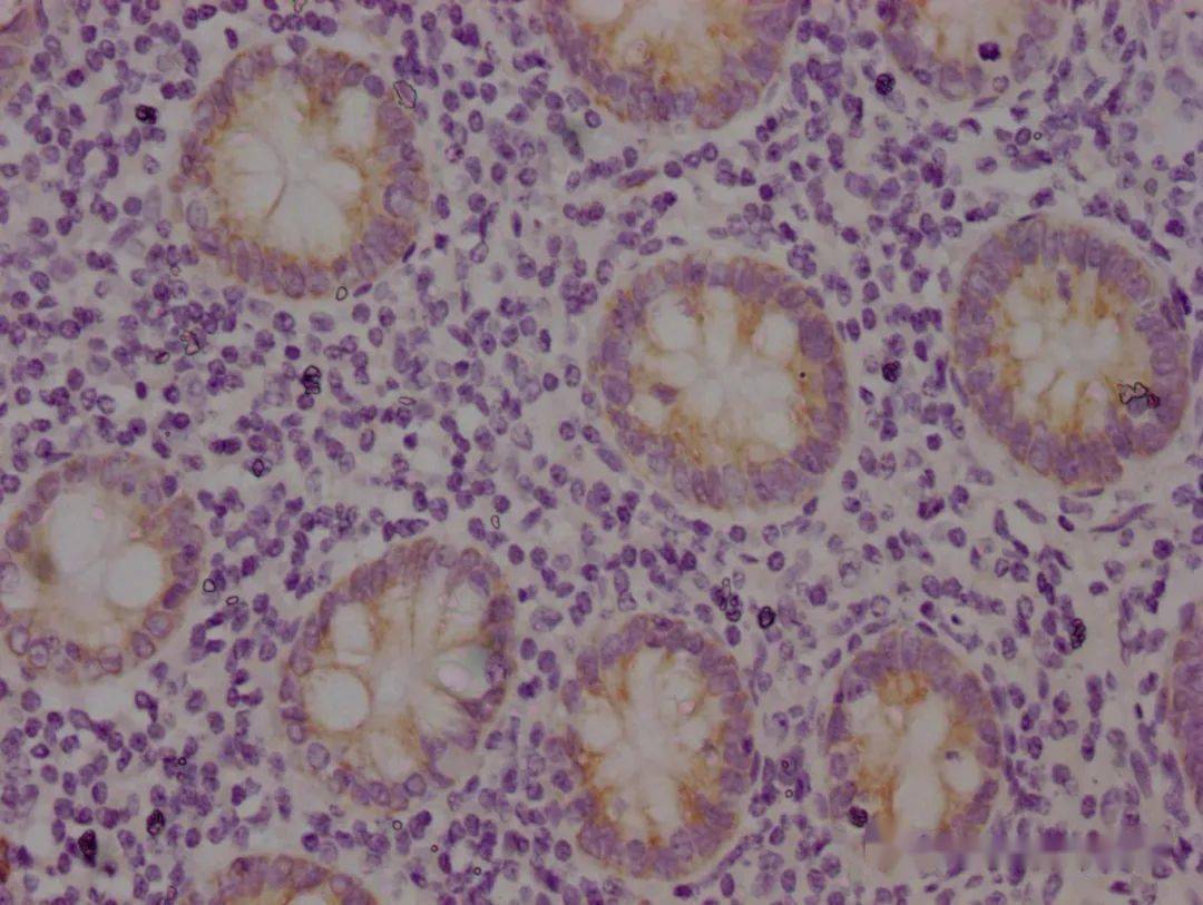 檢測組織:人闌尾組織石蠟組織切片檢測:cytokeratin 19染色左:二抗為