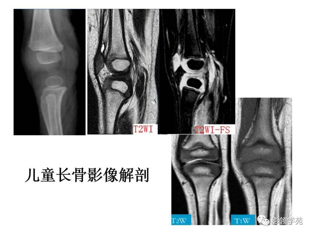 远端全骺分离指肱骨远端包括全部骨骺的软骨块和干骺端之间的分离错位