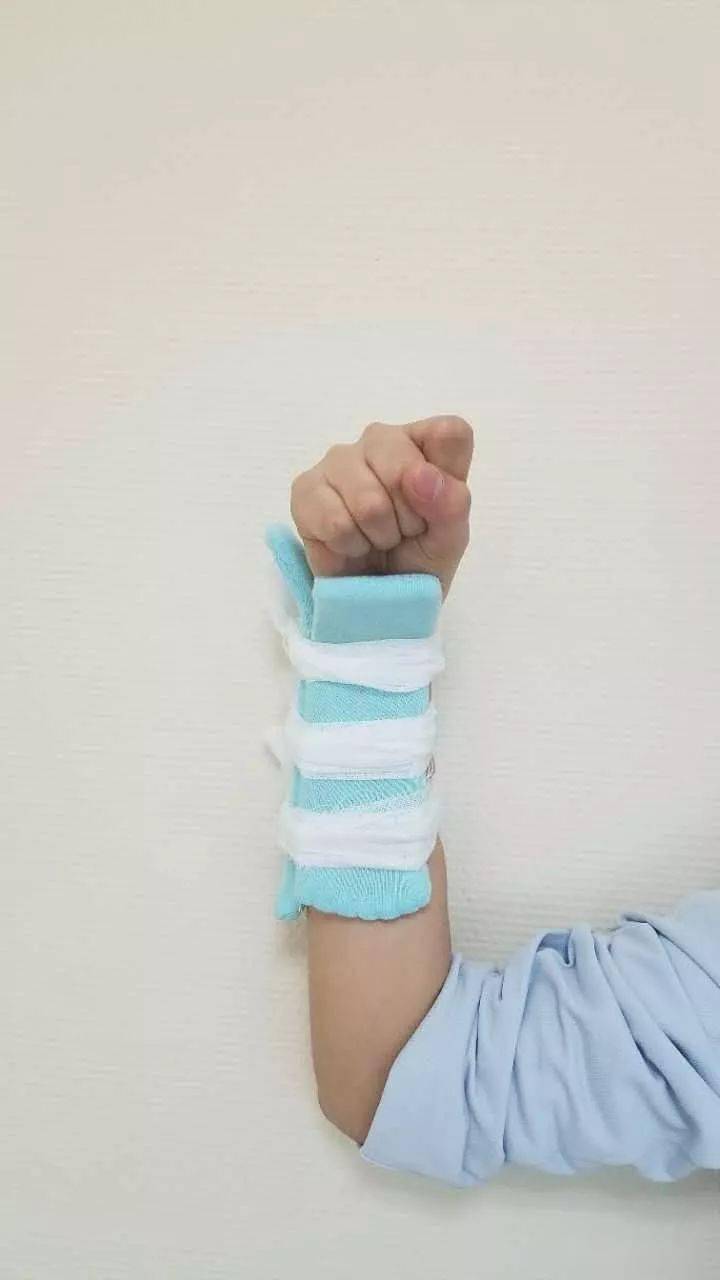 骨折后小夹板固定记住这九点保你妥妥的