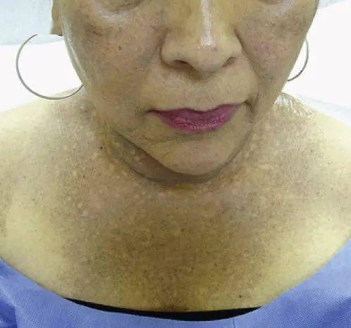 研究快讯前额纤维化脱发的毛发外损害