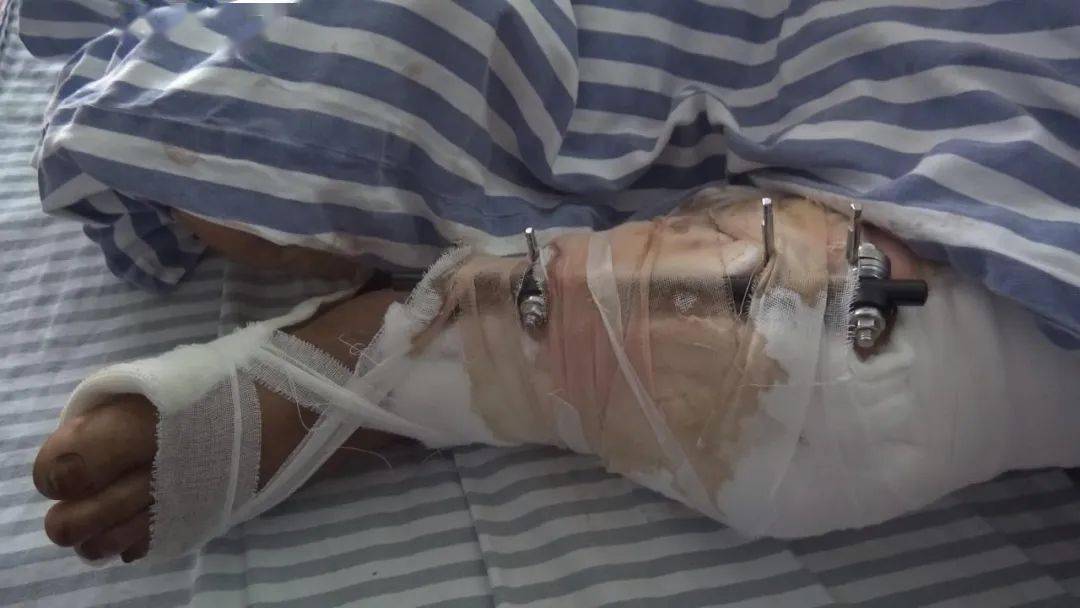 河池一农民工受伤包工头拒绝工伤赔偿司法调解来帮忙