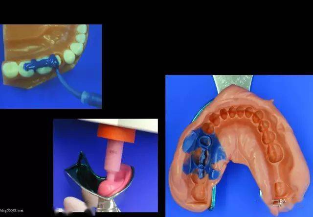 口腔印模 名词解释图片