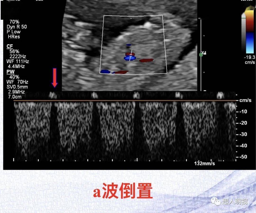 早孕超声结构筛查异常的思路