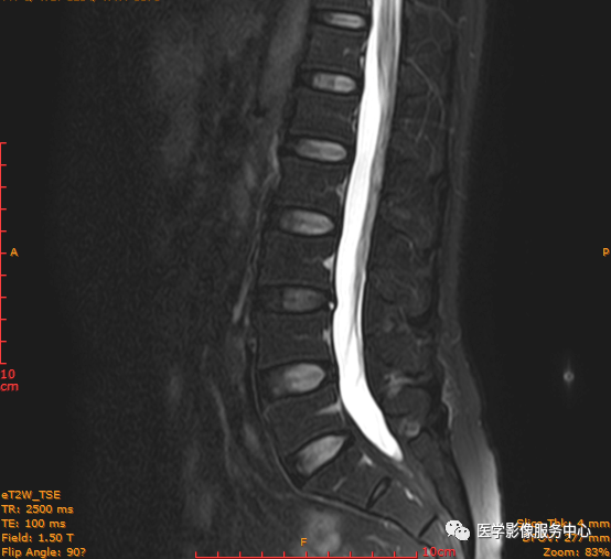 工作中頸椎椎間盤hiz發生率不高圖為c4-5,c5-6椎間盤後緣hiz;hiz可以