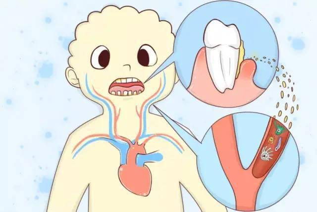 科普口腔健康与心脑血管疾病