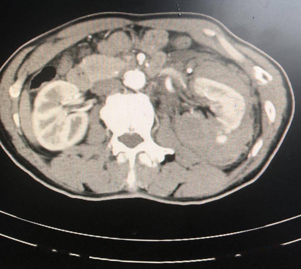 压痛,左肾叩击疼痛明显,进一步ct检查显示患者左肋骨骨折,左肾挫裂伤