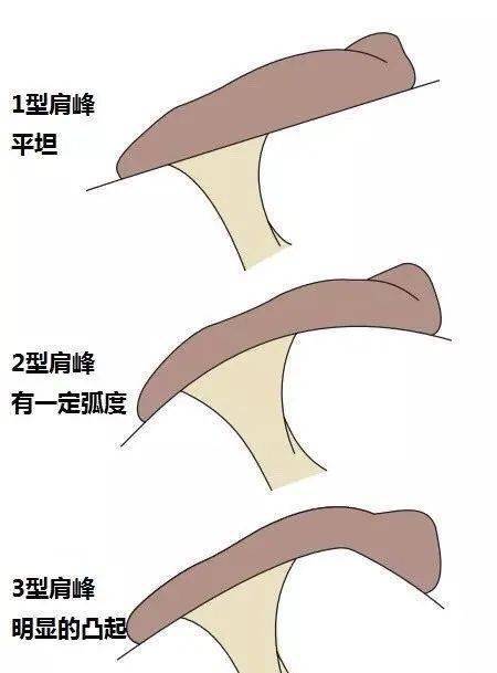 涨姿势肩膀痛有一种疾病叫肩峰撞击综合征