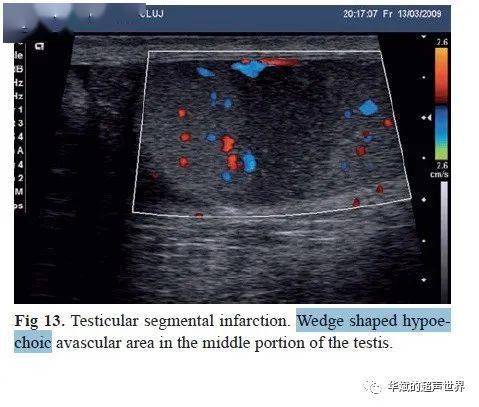 节段性睾丸梗塞令人尴尬的楔形
