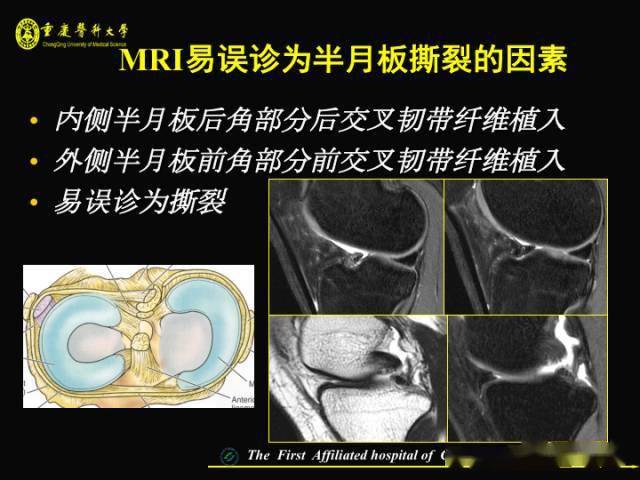 收藏膝關節半月板mri入門看這篇就夠了