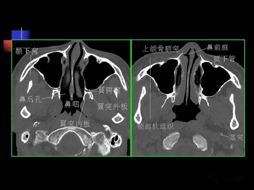 鼻咽部ct解剖
