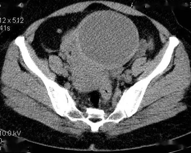 附件区囊性畸胎瘤扭转ct图像(三)鉴别诊断卵巢扭转需注意与急性阑尾炎