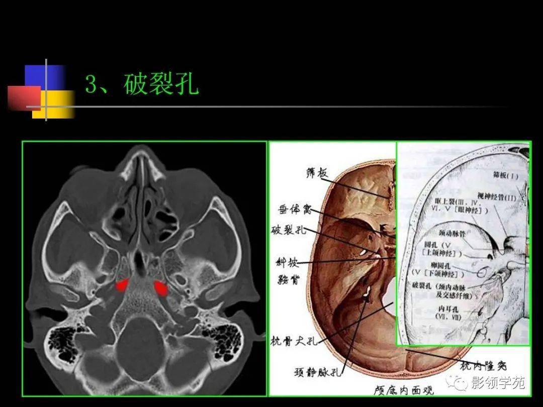 咽鼓管ct位置图片图片