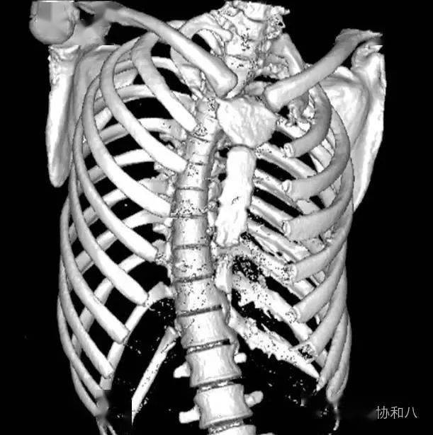 低热乏力胸痛你以为是结核其实是肿瘤惹的祸