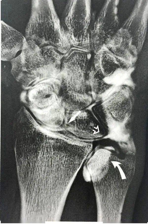圖7-91舟骨月骨和舟骨三角骨韌帶撕裂腕關節造影顯示舟骨月骨(箭頭)和