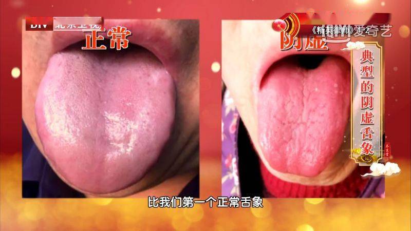 舌头上有裂纹,或是多种疾病征兆,特别是这种舌象可能提示癌变!