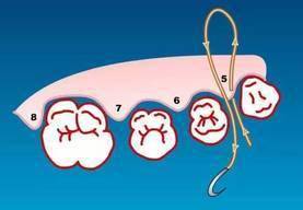 缝合步骤2双乳头悬吊缝合步骤3双乳头悬吊缝合步骤4双乳头悬吊缝合步