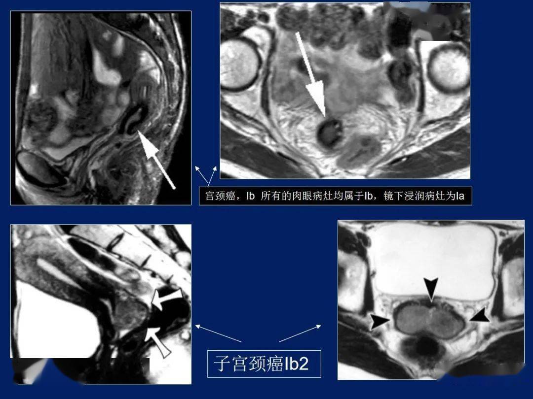 妇产科常见疾病mri表现_子宫