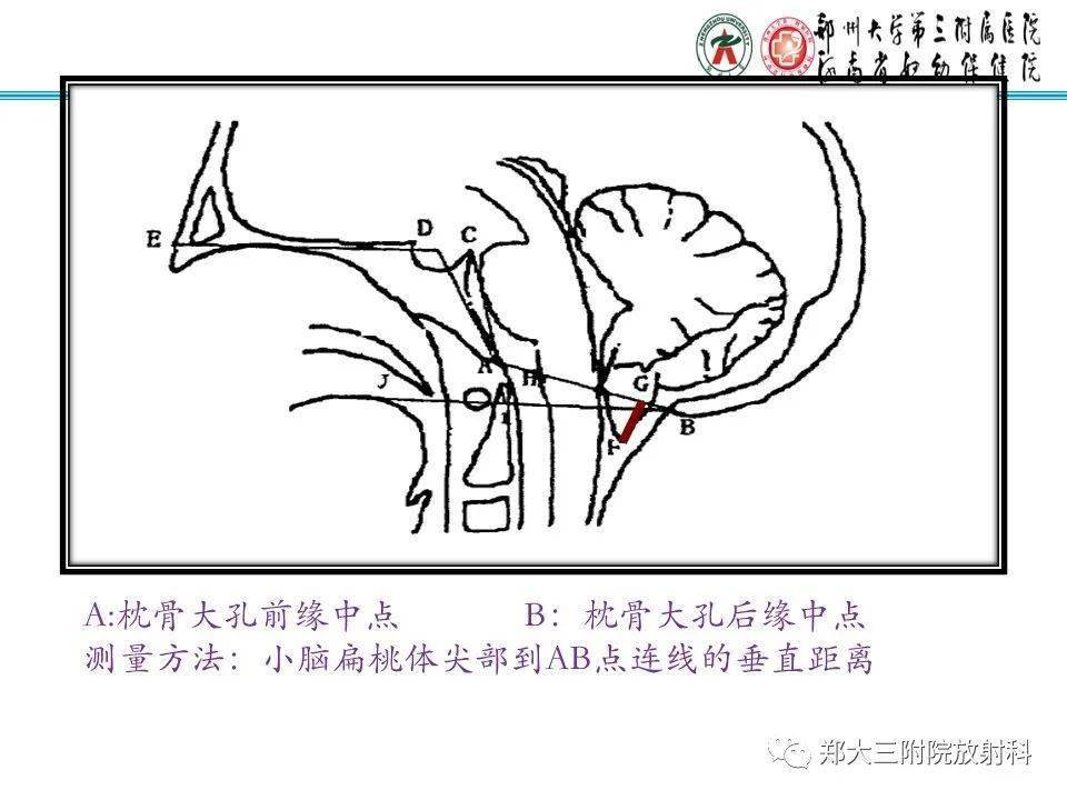 小脑扁桃体下疝畸形图片