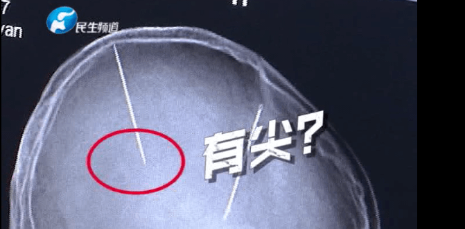 一场车祸后,女子意外发现脑袋里的"秘密"!