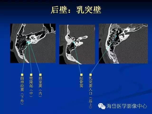 左心耳ct解剖结构图图片