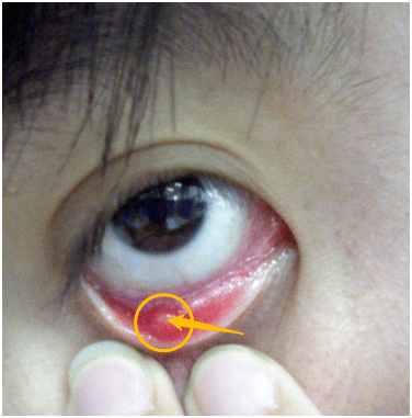 眼睑缘炎的症状及治疗图片