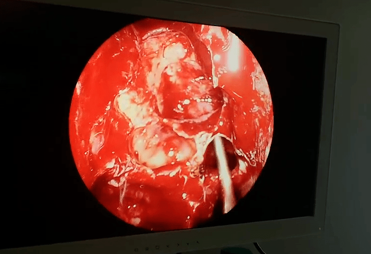 50岁大姐患慢性鼻窦炎20年险些失去嗅觉