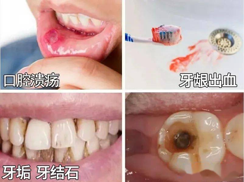 牙龈问题,牙结石,龋齿,牙菌斑,成为中国人最常见的口腔问题.
