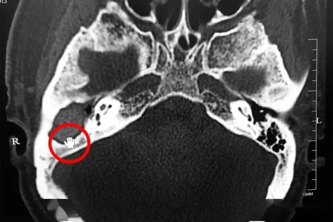 了螺旋ct检查,结果显示,右侧外耳道骨壁,乳突区及听小骨骨质均被破坏