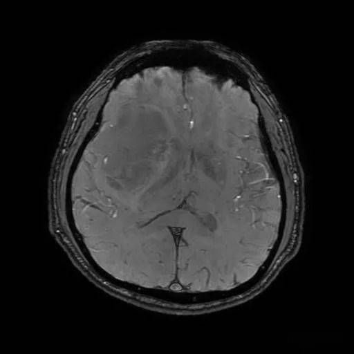 少突胶质细胞瘤